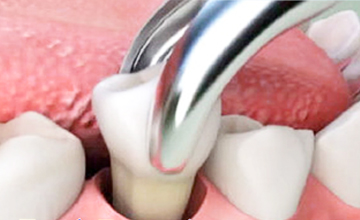 Synder Smiles Tooth Extractions service