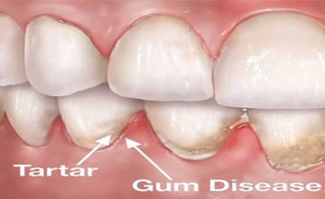 Synder Smiles Periodontal (Gum) Disease service
