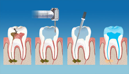 Synder Smiles Endodontics Therapy service