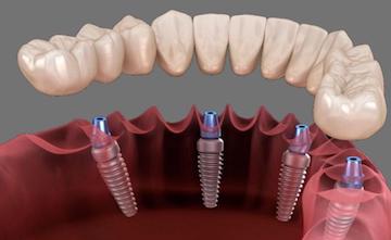 Synder Smiles Root Canal Therapy service